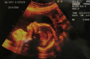 Der Kopf eines Babys auf einem Ultraschall-Bild (Foto: dpa)